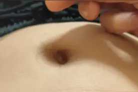 扶阳肚脐贴加上气交灸绝配