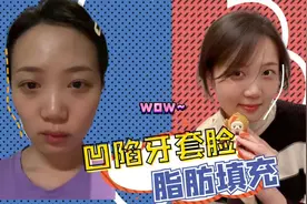 牙套脸矫正恢复全程分享！即刻不水肿不包扎，术后5天很自然…