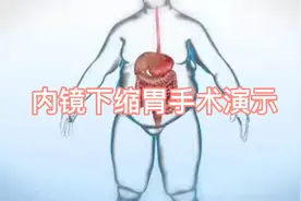 内镜下缩胃手术演示，仅适合极度肥胖患者！