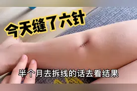 蚊子咬后都能变成皮肤瘤，太可怕了，切除手术花了888块钱太贵了视频封面