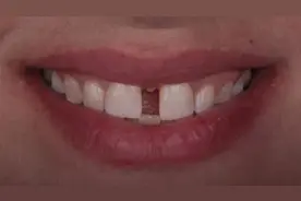 门牙缝隙大，漏财哟。