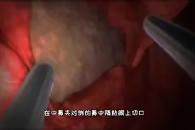 看不到切口的手术，经鼻垂体瘤切除手术，3D演示。。