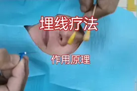 埋线疗法作用原理