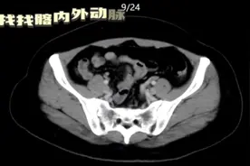 《盆部ct1》#科普 #医学影像 #放射科