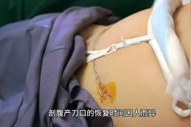 剖腹产多久能恢复视频封面