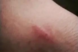 朋友们，我的脚被小猫抓伤了，怎么办呢？