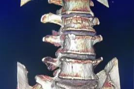 腰2椎体压缩性骨折，骨水泥填充术后视频封面