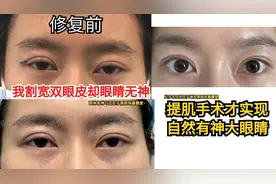 我割宽双眼皮却眼睛无神，为啥呢？提肌手术修复后眼大有神了~视频封面