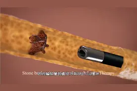 软尿道镜取结石手术过程，3D演示。。视频封面