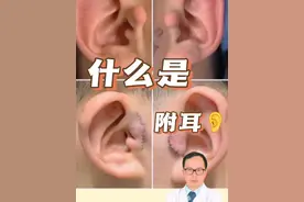 什么是附耳？到底需要怎么处理？#医学科普 #附耳#副耳#瘢痕 #健康守护计划