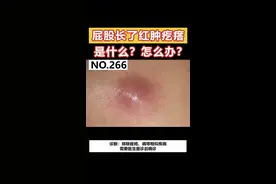 屁股上长了红肿疙瘩是什么？怎么办？#皮肤 #火疖子 视频封面