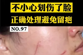 脸不小心被指甲划伤了，没处理好，容易留疤，非常影响颜值，所以，第一时间正确处理很关键#疤痕 #医学科普 