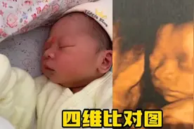 顺产头部挤压变形多久可以恢复？