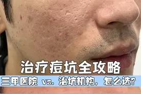 痘坑治疗选错了可能会更糟！看完这条视频，帮你省下冤枉钱和精力 #痘坑#痘坑治疗#点阵激光视频封面