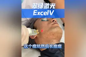 翠绿激光excelV脱络腮胡的即刻观察