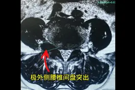 一例极外侧腰椎间盘突出的微创治疗，局麻全程无痛，体验感杠杠的
