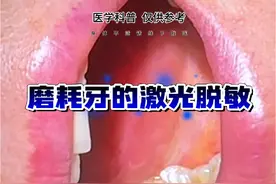 磨耗牙齿的激光脱敏 #牙齿敏感怎么办 #激光口腔诊疗 #牙齿磨耗 #激光脱敏 #口腔医生赵晶 @抖音医疗健康小助手 @健康北京 @健康中国 @DOU+小助手视频封面