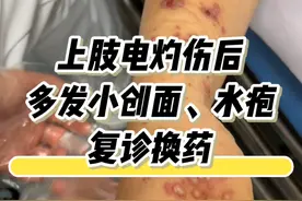电灼伤后多发小创面水疱，湿性愈合换药 本期临床病例实录没有很复杂也没有很猎奇，但很干货。从头到尾每个步骤都很清楚，基本上大家日常生活中的小创面都可以用相似的方法处理。还讨论了水胶体和银离子敷料的使用，都是网友们也会问到的问题。总之希望大家能从中了解到湿性愈合的具体应用操作～ #伤口 #烧伤 #整形外科