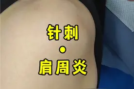 肩周炎，针灸。 #肩周炎 #中医 #分享日常扎针 #医学科普 #硬核健康科普行动
