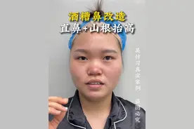 酒糟鼻大改造！直鼻加山根抬高！ #鼻整形#鼻修复#吴付习#吴付习软糖鼻#变美