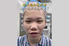 超大蒜头鼻改善 ｜ 鼻子只有鼻毛好看了！ #隆鼻#变美#吴付习软糖鼻#硬核健康科普行动#蒜头鼻