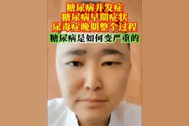 糖尿病并发症，自然分析病历，糖尿病尿毒症，糖尿病早期症状，糖尿病肾病，糖尿病视网膜病变视频也比较长，讲述我8年以来从糖尿病，发展到糖尿病并发症尿毒症晚期的真实经历，希望我的个人真实，尽力分享，能够帮到大家，能够给大家敲一个警钟。#糖尿病 #糖尿病并发症 #肾病 #癌症晚期 #高血压
