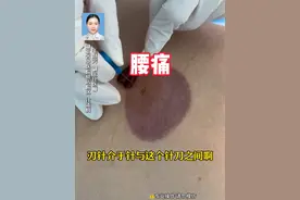 刃针治疗弯腰负重导致的腰痛 #腰痛 #中医 #刃针 #抖出健康知识宝藏 #毛慧芳医生