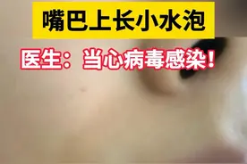 嘴唇上起小水泡，30s医生教你如何快速消除 #单纯疱疹#上火#烂嘴角#病毒#抖出健康知识宝藏