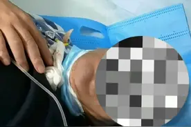 #气管切开 #气管切开#气管封闭 #气管镜#微创手术 病人气管切开后大约3个月，又出现气切上端气管瘢痕封闭，近日给予气管镜下微创处理，重新打开闭塞部分，病人可以说话了。@抖音热点宝 @抖音短视频视频封面