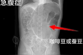 两例典型案例，平片见咖啡豆或蚕豆征#医学影像 #急腹症视频封面