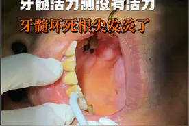 牙髓坏死根尖发炎了，牙髓经测试没有活力，需要根管治疗 #根尖炎 #根尖周炎 #牙髓活力测试 #根管治疗 #口腔医生赵晶 @DOU+小助手 @健康中国 @健康北京 @抖音医疗健康小助手