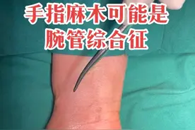 手指麻木可能是腕管综合征引起的 手指大拇指侧三个半手指麻木可能是腕管综合征引起的视频封面
