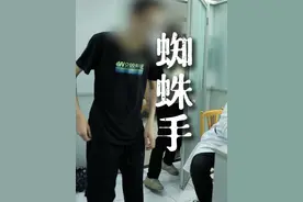 今天门诊遇到一个特殊病人 病人的手像“蜘蛛”的形状一样，整个人非常消瘦#蜘蛛手 #马凡综合征 #骨科 #医者仁心