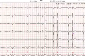 房性早搏伴差传的多样性视频封面