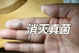 #真菌感染 #手脱皮 #过氧化氢 可以看到喷完过氧化氢后
