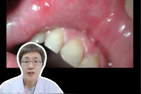 以为是#口腔溃疡，其实是梅毒！口腔溃疡和梅毒长得很像，医生教你区分和解决#医学科普 #传染 #硬核健康科普行动 #科普