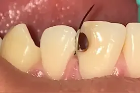 牙齿坏了一小块怎么补的呢？ #牙齿 #补牙 #解压 #牙医日常 #硬核健康科普行动