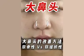 大鼻头的改善方法#大鼻头 #大鼻头缩小 #成都隆鼻 #肋软骨隆鼻