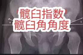 髋臼指数，髋臼角度数，髋关节发育不良，#髋关节发育不良 #发育性髋关节脱位 #髋关节筛查 #髋关节 #医生日常