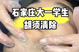 石家庄大一学生胡须清除，你看着多大呢？#络腮胡 #脱胡子 #男士必备视频封面