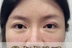 #双眼皮蜕变记 双眼皮失败3次，从韩国来做第4次双眼皮修复#眼修复 #双眼皮修复 #双眼皮  #闫品行视频封面