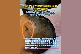 4月10日，湖南长沙。9岁女生被老师砸伤头骨案今日二审宣判。妈妈首次公开孩子伤口照片， “7厘米深 头骨是一个洞”。视频封面