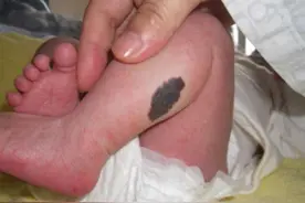 宝宝长“胎记”，和妈妈孕期的3件小事有关，为了娃颜值一定忍住图片