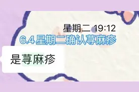 赵露思荨麻疹挑战，她如何以乐观战胜病魔？图片