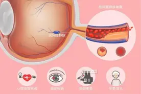 小阻塞，大问题——警惕视网膜静脉阻塞图片