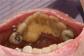 耗时3个月亲测网上爆火牙粉！短时间去除牙黄、牙结石的竟是它！图片