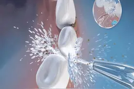 洗牙时喷砂与不喷砂的区别：选择适合你的口腔护理方式图片