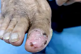 老人脚趾周围冒出黑点竟是黑色素瘤 ，胎记、痣突然变大变深要当心！图片