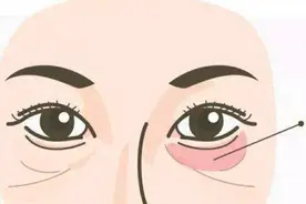 眼袋大，多半是脾虚，教你一招，眼袋下垂、浮肿通通搞定图片