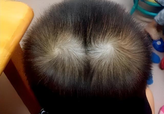 孩子头顶“2个旋”，到底代表什么？父母别不在意，看完涨知识了